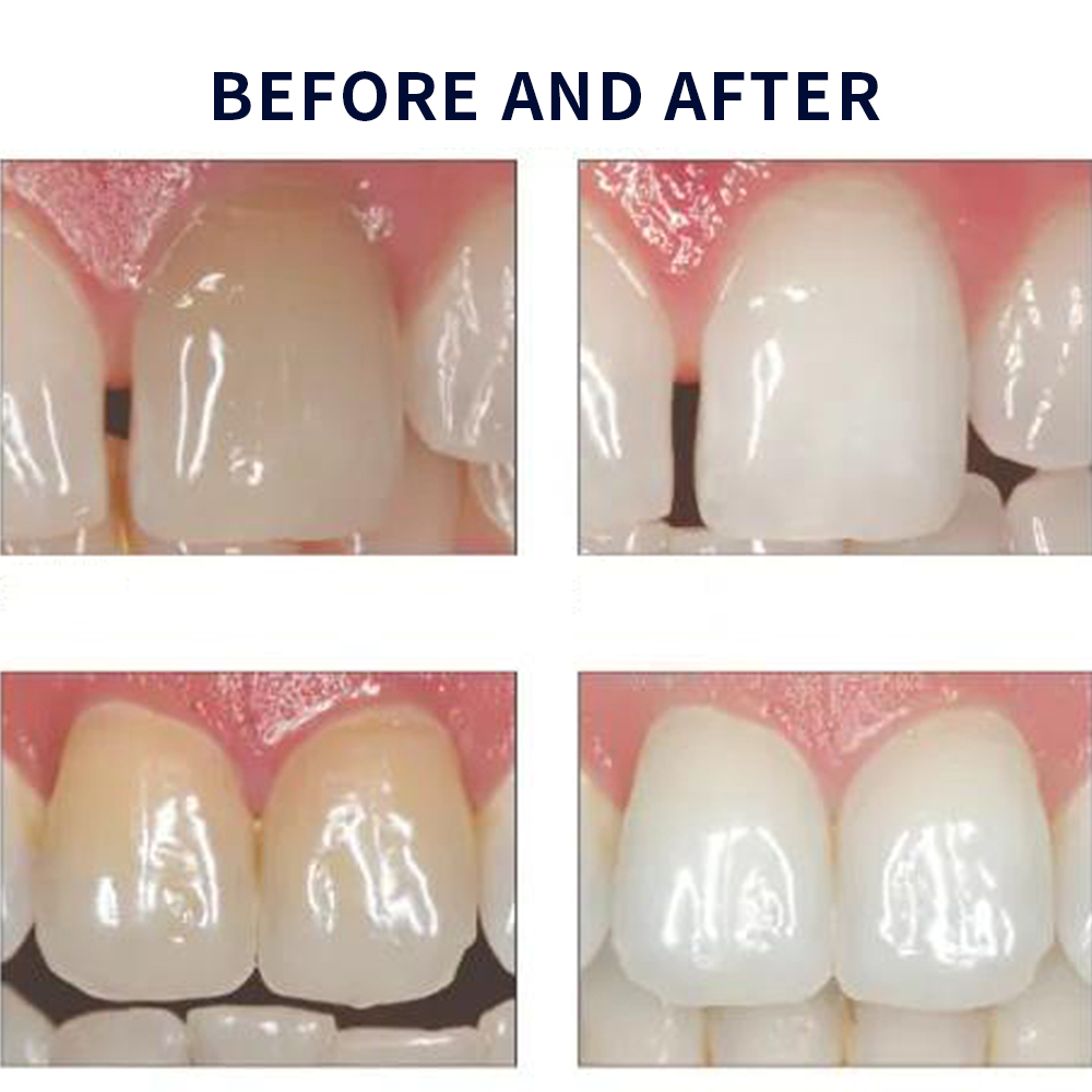 유백광 미백 20% PF 20 16 젤 키트, 초강력  - Teeth Whitening Shade Guide 리뷰 및 가격