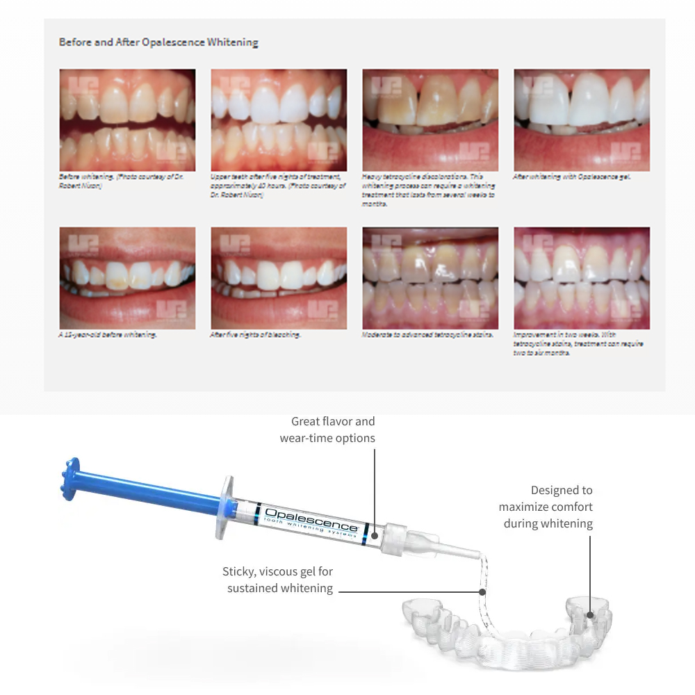 유백광 미백 20% PF 20 16 젤 키트, 초강력  - Teeth Whitening Shade Guide 리뷰 및 가격